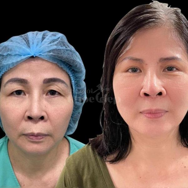 Cắt mí & Nhấn mí Mini Deep – Mắt to rõ mí, khắc phục mí lót hiệu quả - 2/3