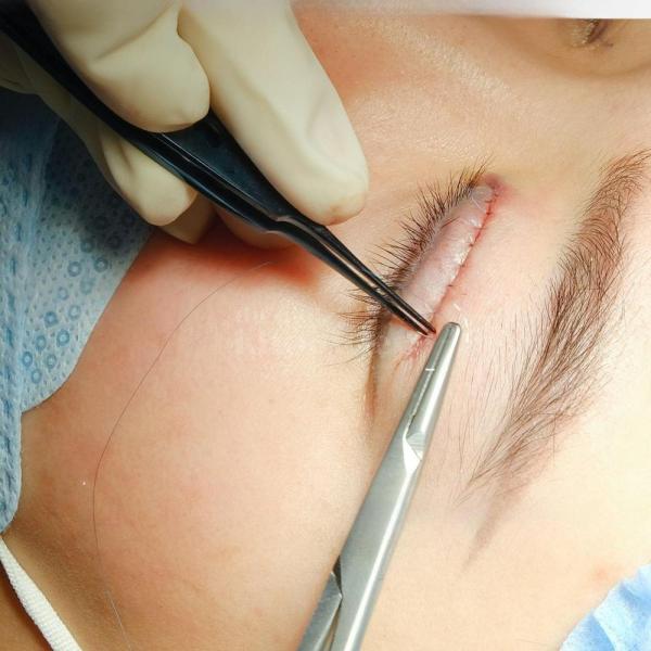 Cắt mí & Nhấn mí Mini Deep – Hết sụp mí, mắt sáng, trẻ trung - 1/3