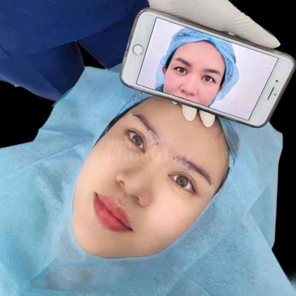 Cắt mí & Nhấn mí Mini Deep – Hết sụp mí, mắt sáng, trẻ trung - 3/3