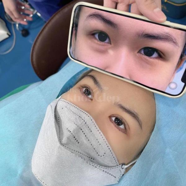 Sửa cắt mí hỏng, mí lệch bằng công nghệ Cắt mí & Nhấn mí Mini Deep - 1/3