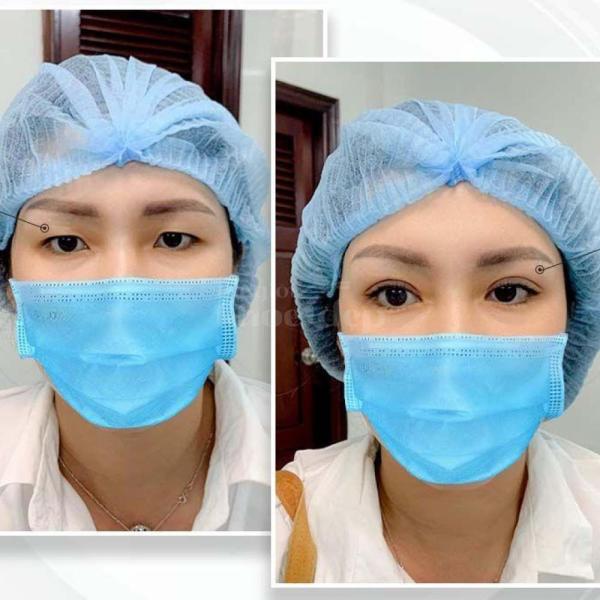 Cắt mí Plasma không sẹo – Công nghệ trẻ hóa mắt, hồi phục chỉ sau 5 ngày - 1/4