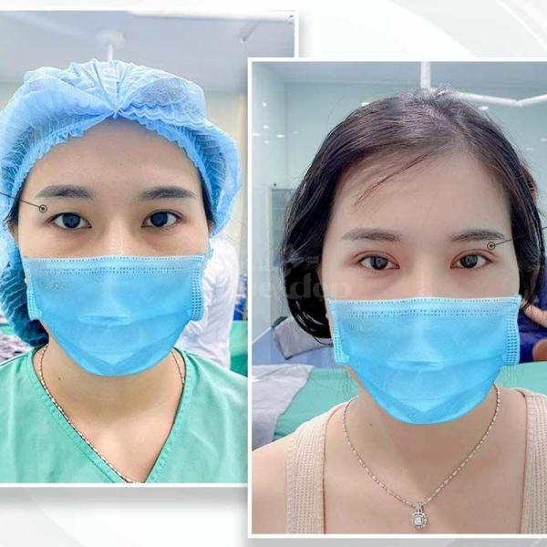 Cắt mí Plasma không sẹo – Công nghệ trẻ hóa mắt, hồi phục chỉ sau 5 ngày - 2/4
