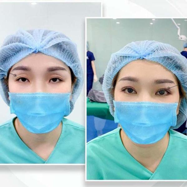 Cắt mí Plasma không sẹo – Công nghệ trẻ hóa mắt, hồi phục chỉ sau 5 ngày - 3/4
