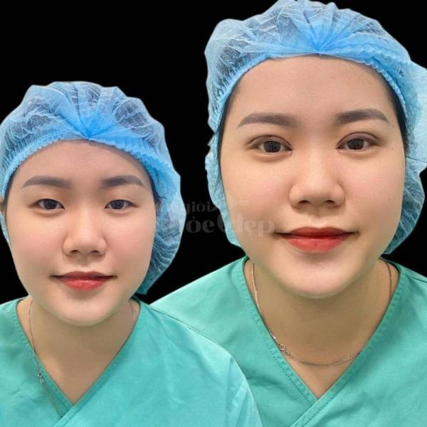 Combo Cắt mí + Lấy mỡ mắt dưới – Giải pháp trẻ hóa mắt toàn diện, tự nhiên, duy trì lâu dài - 2/4