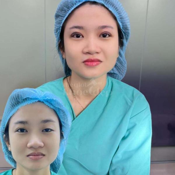 Combo Cắt mí + Lấy mỡ mắt dưới – Giải pháp trẻ hóa mắt toàn diện, tự nhiên, duy trì lâu dài - 3/4