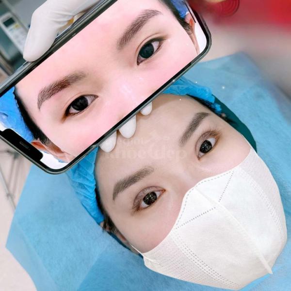 Combo Cắt mí + Lấy mỡ mắt dưới – Giải pháp trẻ hóa mắt toàn diện, tự nhiên, duy trì lâu dài - 4/4