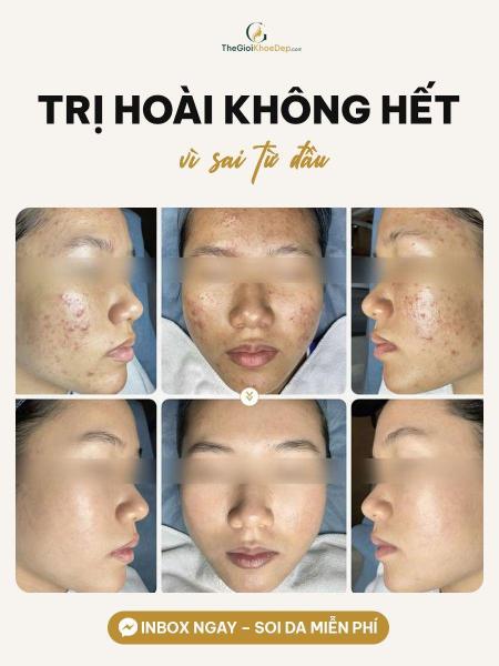 Điều trị mụn - 1/4