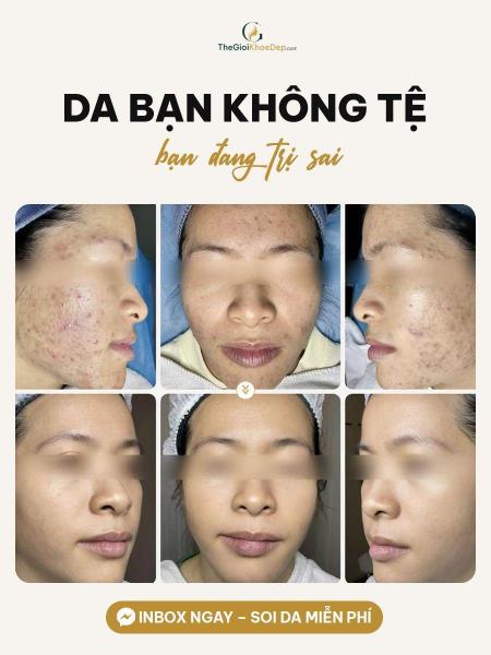 Điều trị mụn - 2/4