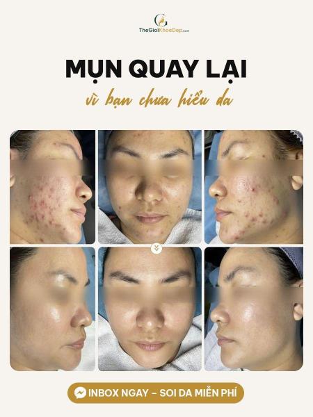Điều trị mụn - 3/4