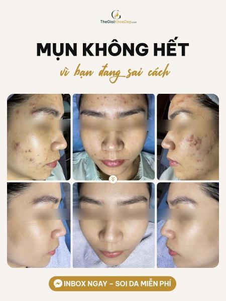 Điều trị mụn - 4/4