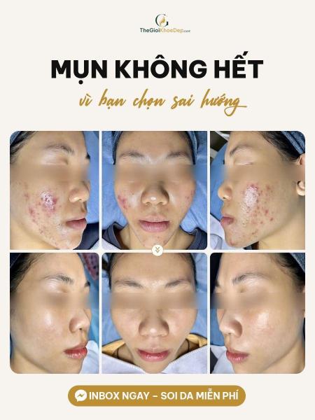 Trị mụn viêm - 2/4
