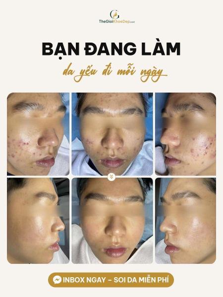 Trị mụn viêm - 4/4