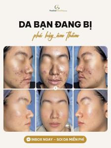 Trị mụn tái phát