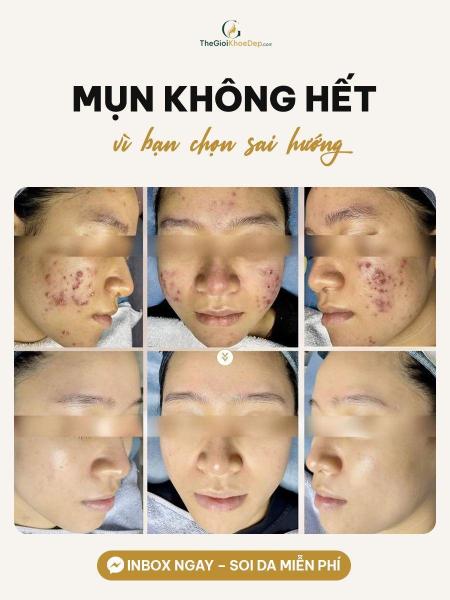 Trị mụn tái phát - 2/4