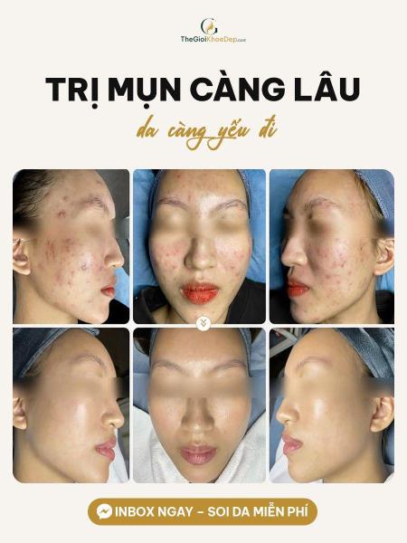 Trị mụn tái phát - 3/4