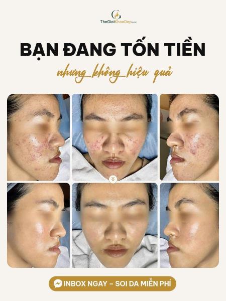 Trị mụn ẩn - 4/4